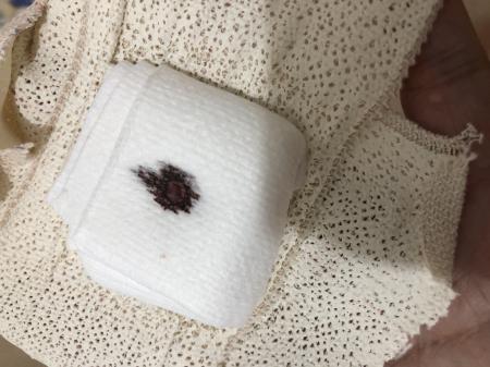 Biopsy