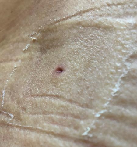 Biopsy