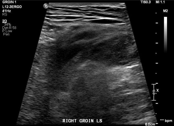 Hernia Surgery - Ultrasound scan confirmed a 2.3cm hole in my tummy.