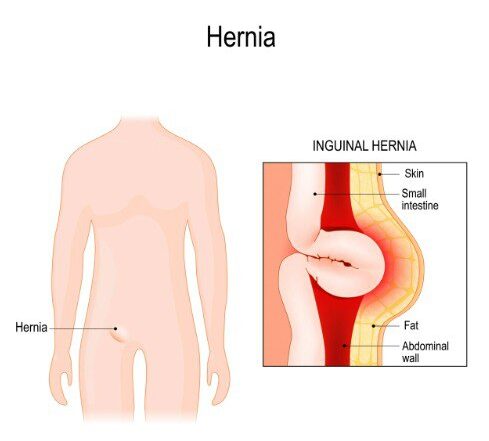 hernia location