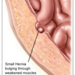 hernia side view