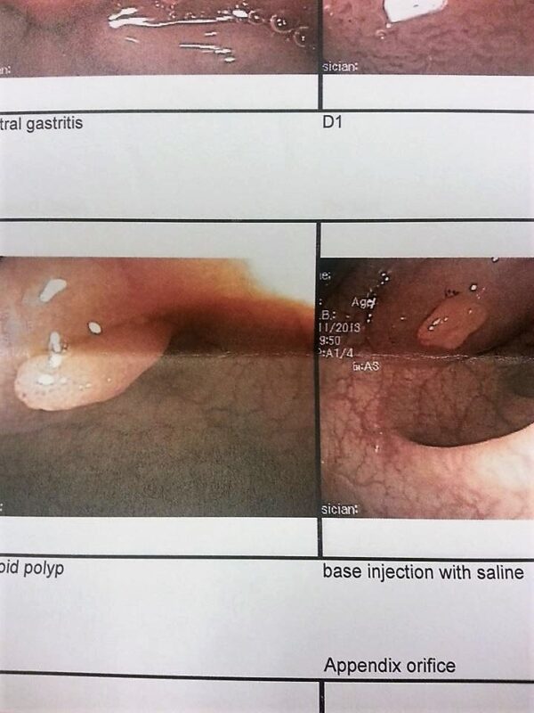 2013 Colonscopy Report