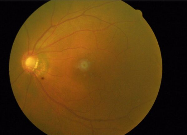 2018 Retina scan of my Left Eye