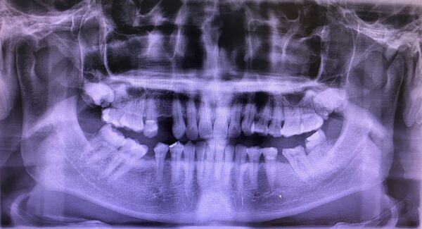 180 degrees scan of my teeth, displayed as 2D Photo