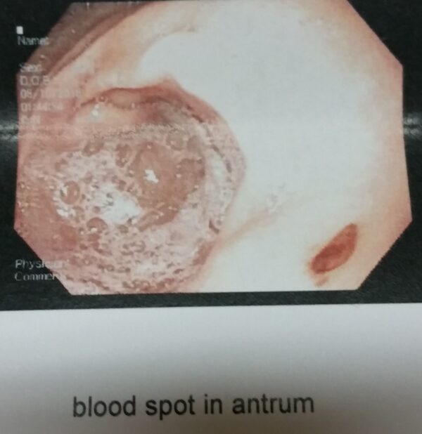 Blood stain in Stomache
