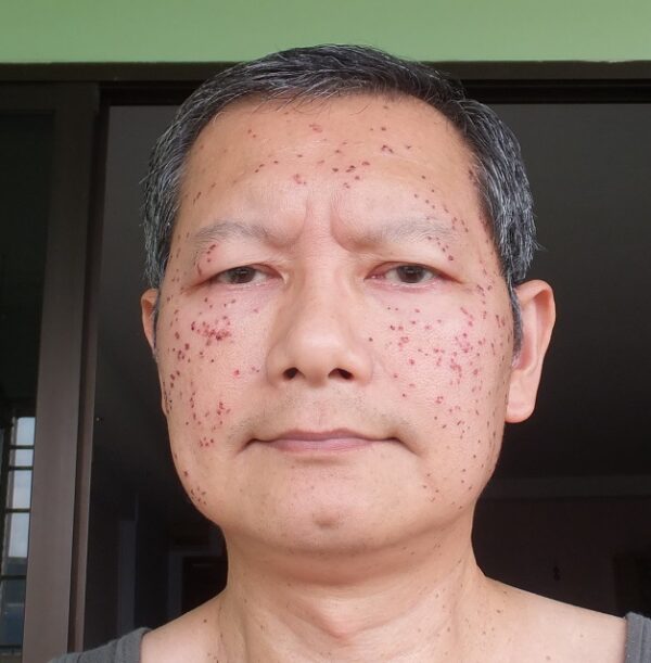 Just after the Face Electrosurgery - side view