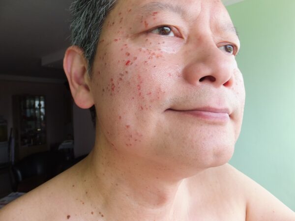 2010 - Before brown spots and skin tags removal