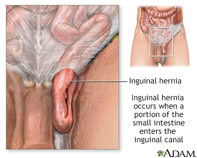 What is Inguinal hernia