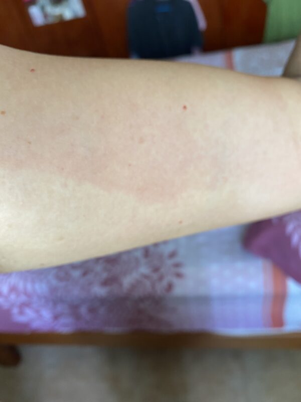 2021 Lymphoplasmacytic Lymphoma - Sharing my experience with 3rd vaccination booster shot — photo