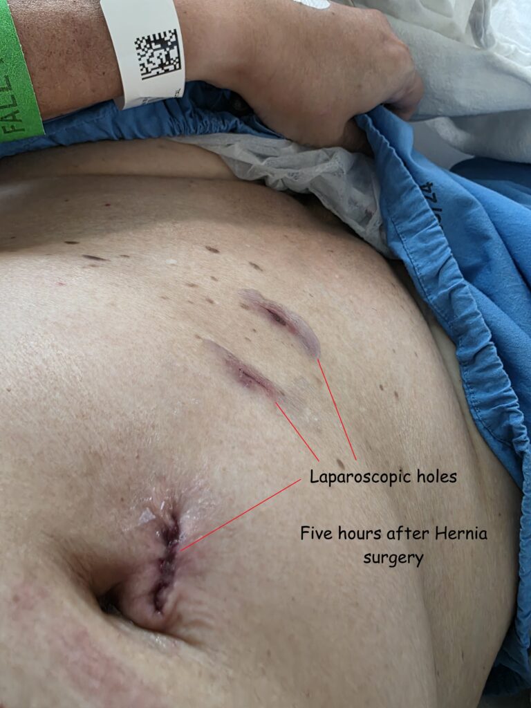 Right after Laporoscopic hernia surgery at hospital ward recovering from full anesthesia