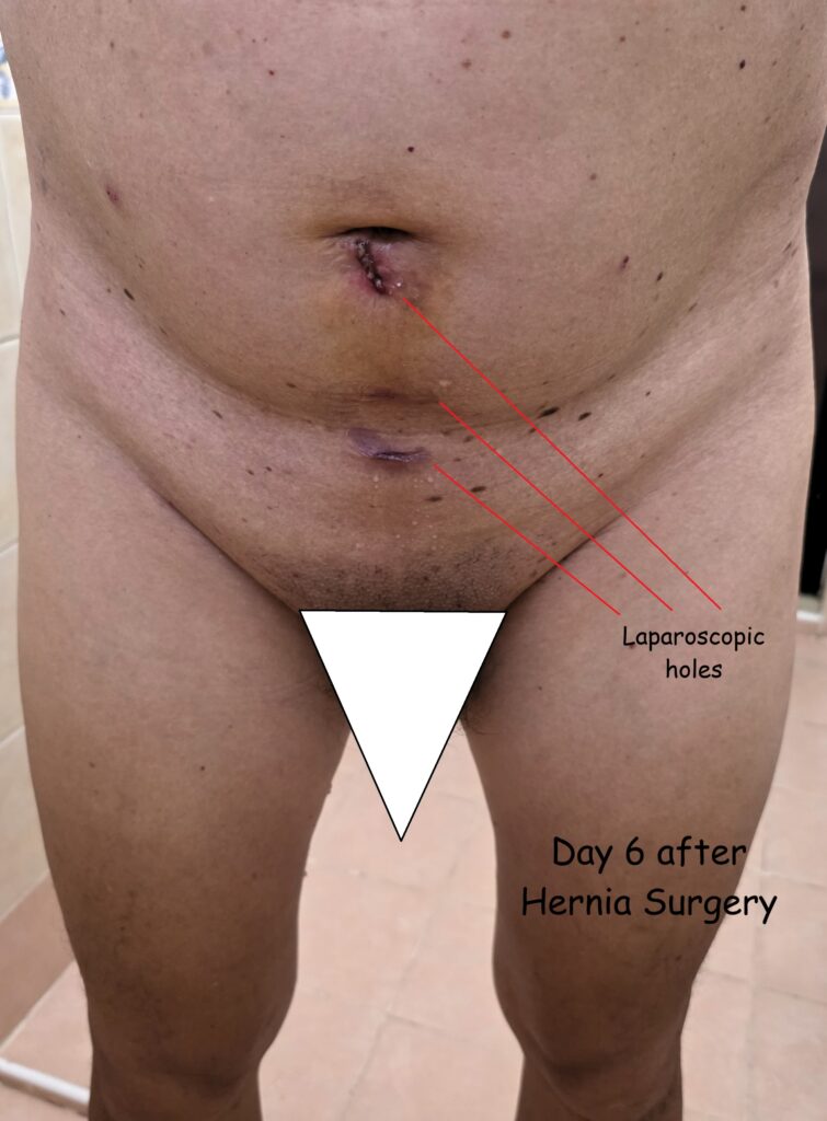 Six days after Laparoscopic hernia surgery, the three laparoscopic holes are healing well