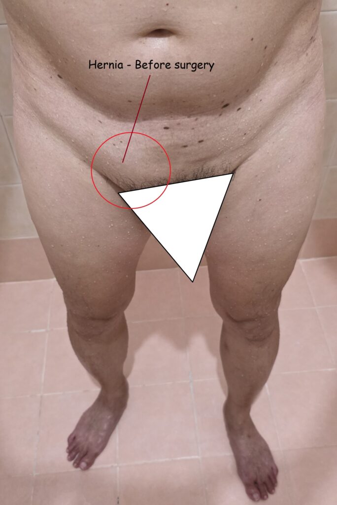 Inguinal hernia on my right side - Before Laparoscopic Hernia Surgery