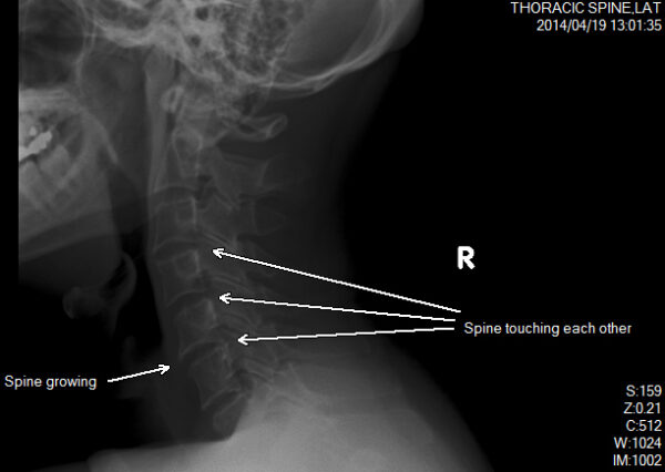 Spine Neck