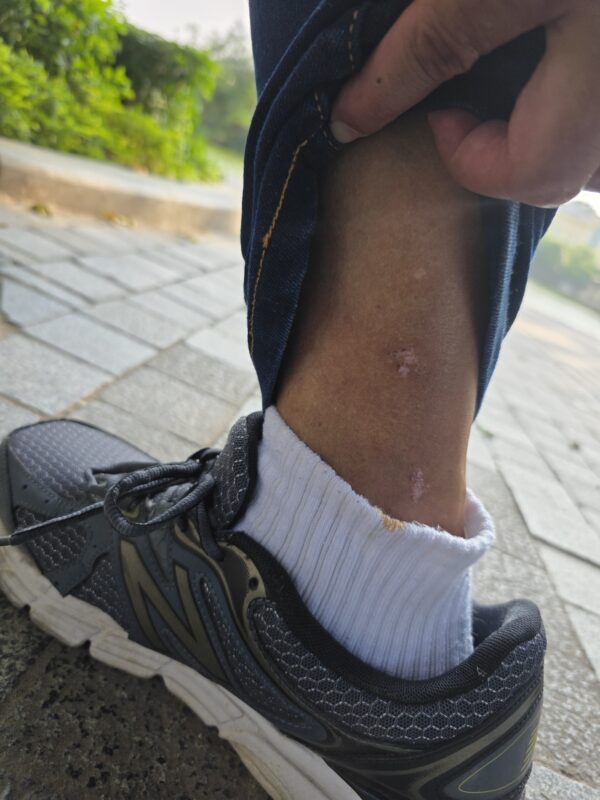 2026 - Accident - Ran over by a motorbike at Hanoi Vietnam while crossing a road