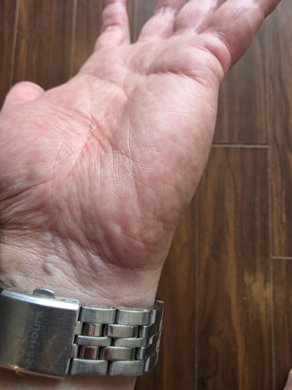 Photo taken after back to hotel and cleanup of skin tears