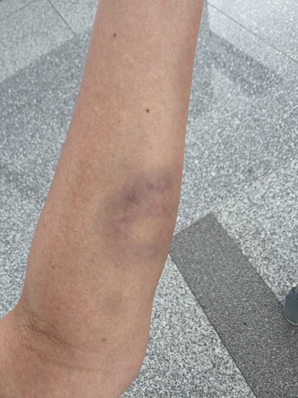 Two days after the motorbike accident